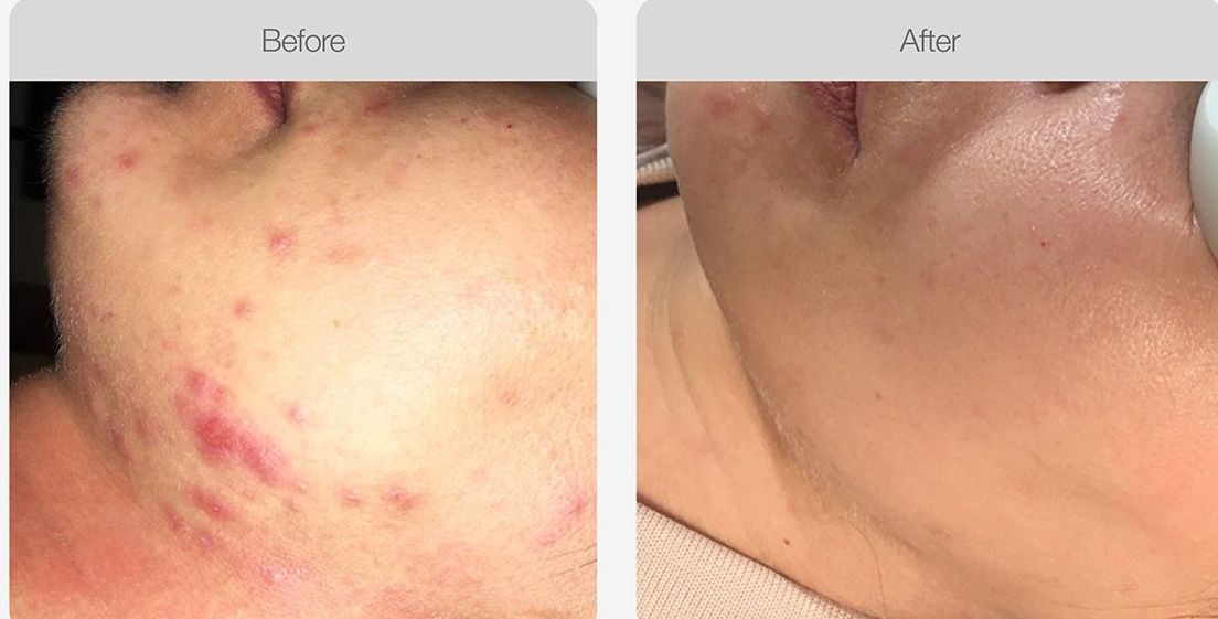 A woman with acne on her face is touching her face with her hand – Rapid Creek, NT - Urban Wax & Beauty