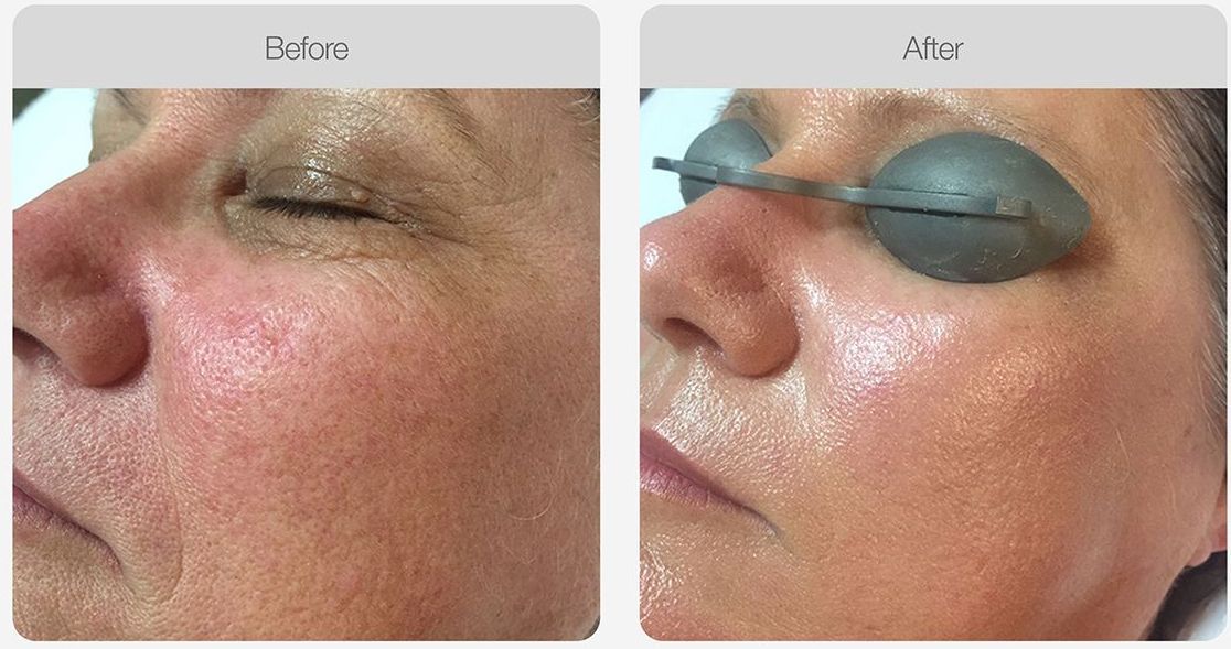 A woman is receiving laser rejuvenation – Rapid Creek, NT - Urban Wax & Beauty A woman is receiving laser rejuvenation – Rapid Creek, NT - Urban Wax & Beauty