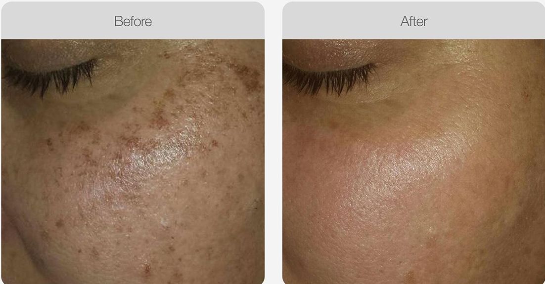 A woman is getting a laser treatment on her face – Rapid Creek, NT - Urban Wax & Beauty A woman is getting a laser treatment on her face – Rapid Creek, NT - Urban Wax & Beauty