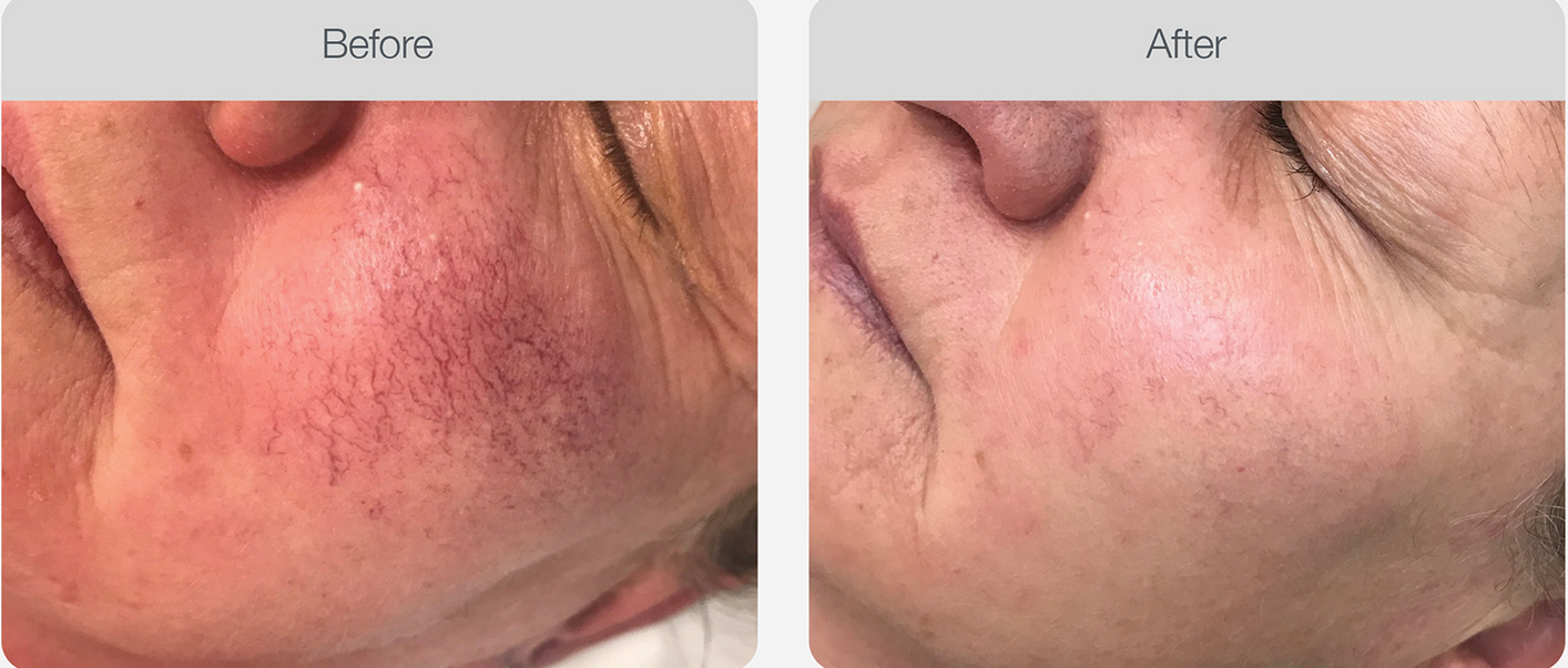 Examining face skin with rosacea problems – Rapid Creek, NT - Urban Wax & Beauty Portrait of a beautiful young woman looking over her shoulder and smiling outdoors – Rapid Creek, NT - Urban Wax & Beauty