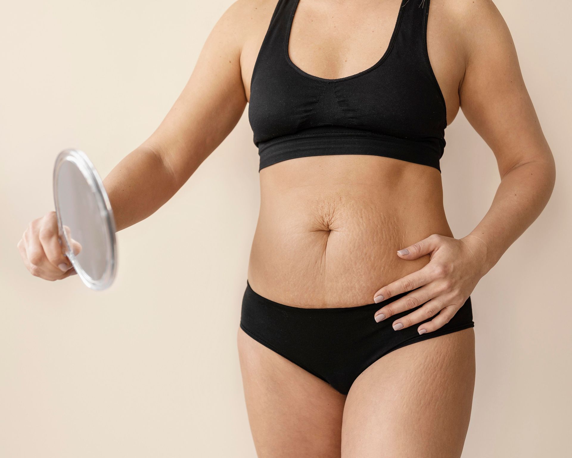 A lipoabdominoplastia minimamente MILA  e eficaz na remocao de estrias ou flacidez extrema