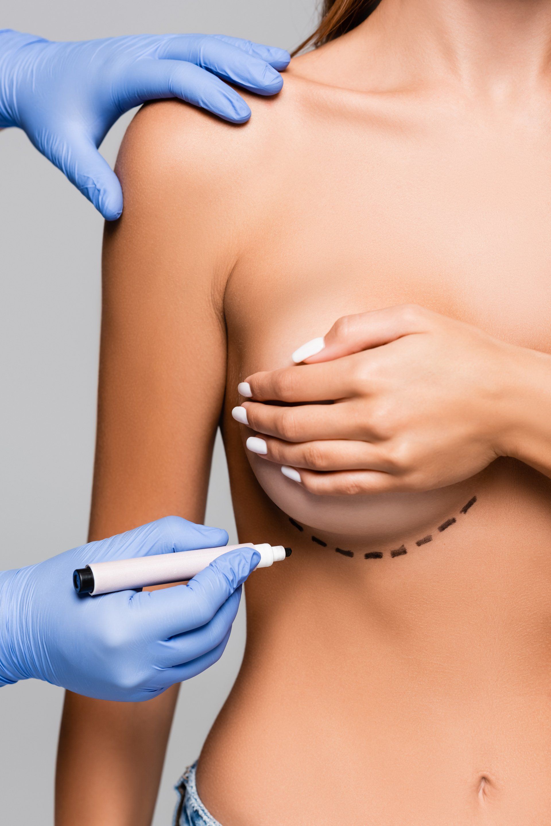 Mamoplastia de redução em SP Mamoplastia de redução em SP