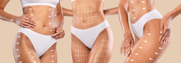 Quais áreas do corpo são tratadas com a lipoabdominoplastia MILA Quais áreas do corpo são tratadas com a lipoabdominoplastia MILA