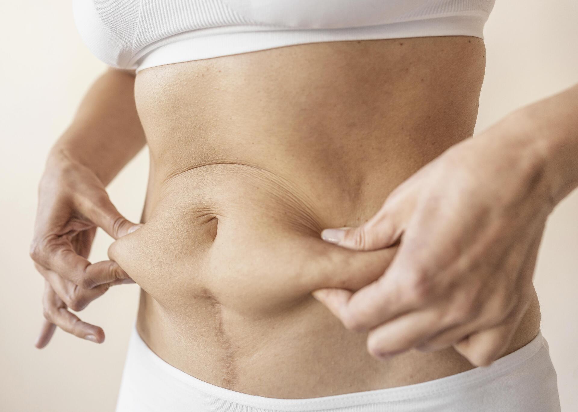 O que é a abdominoplastia? O que é a abdominoplastia?