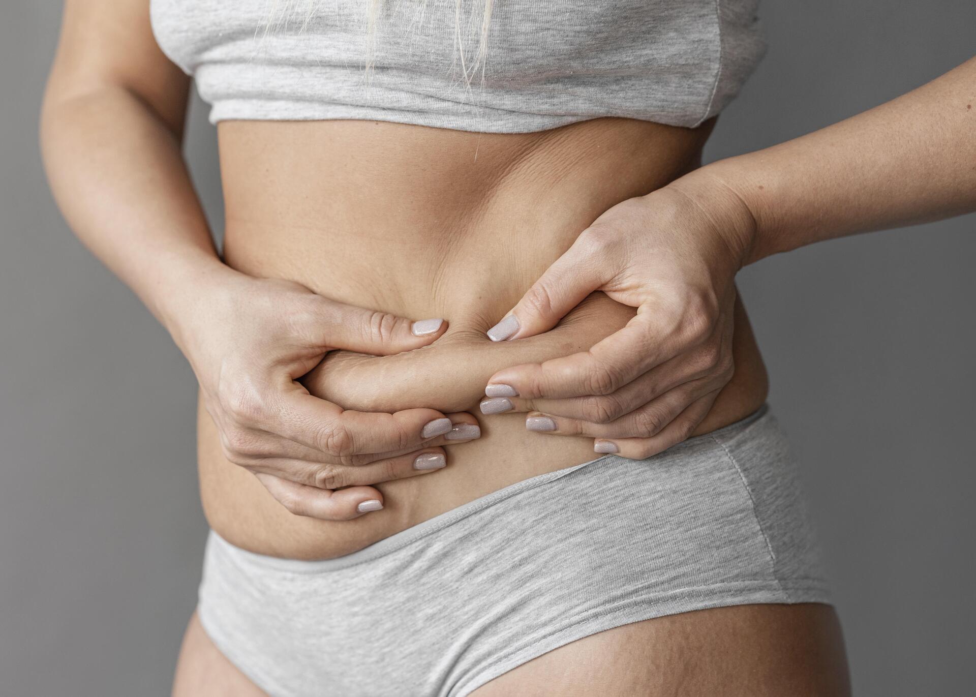 Quem faz lipo pode voltar a ter barriga Quem faz lipo pode voltar a ter barriga