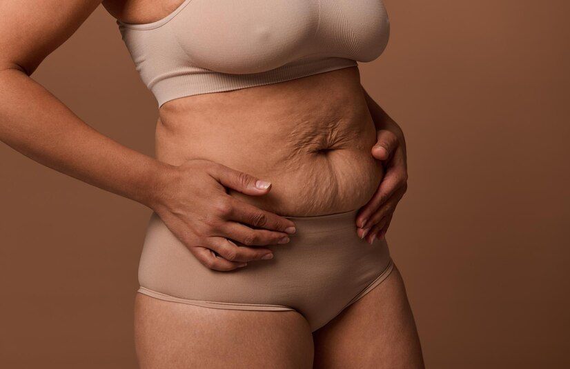 Cirurgia Robótica para Diástase em Pacientes Pós-Parto: Vantagens e Cuidados Cirurgia Robótica para Diástase em Pacientes Pós-Parto: Vantagens e Cuidados
