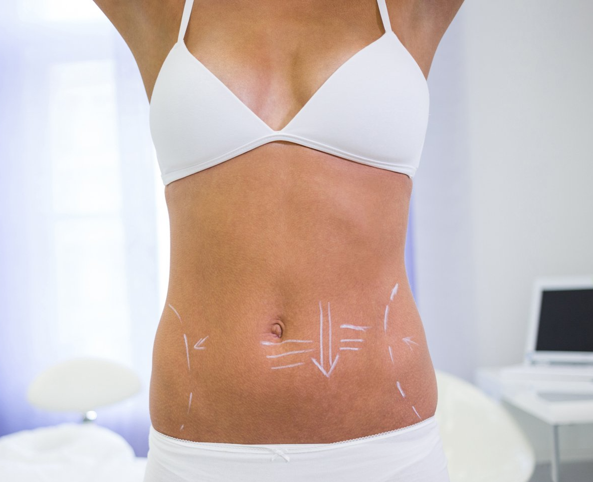 Lipo Renuvion em São Paulo Lipo Renuvion em São Paulo