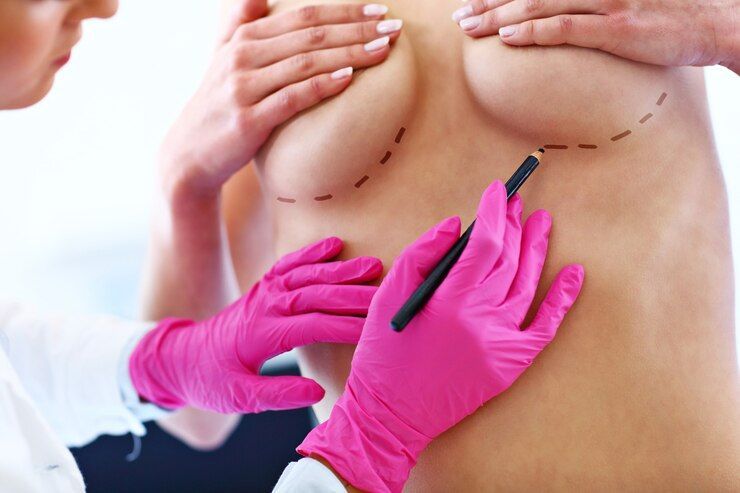Mamoplastia redutora deixa cicatriz Mamoplastia redutora deixa cicatriz