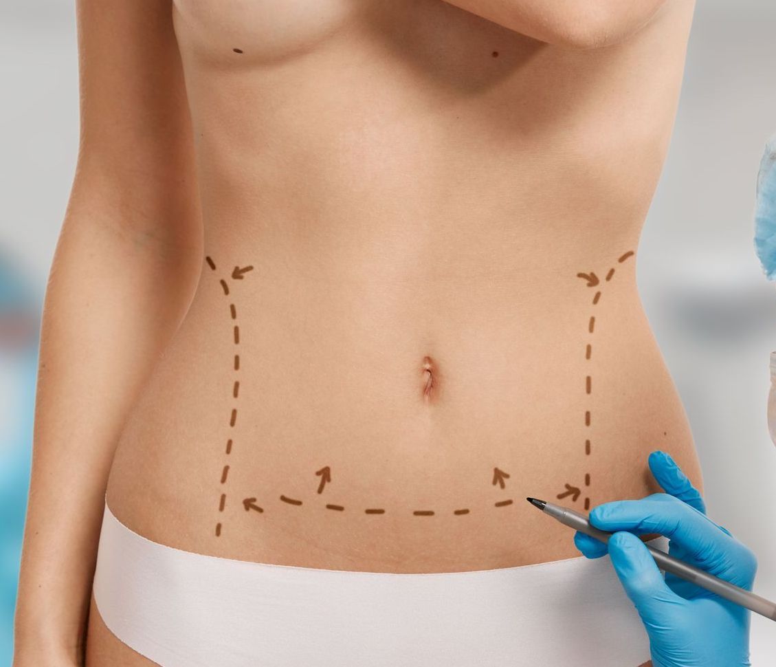 Como é feita a lipoaspiração Como é feita a lipoaspiração