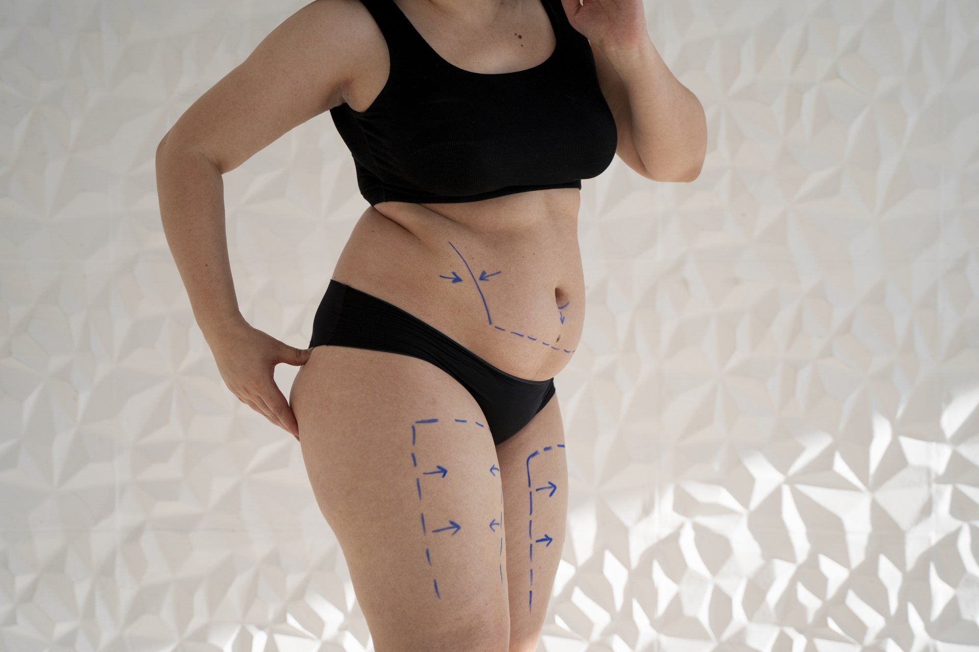 Como é feita a lipoaspiração Como é feita a lipoaspiração