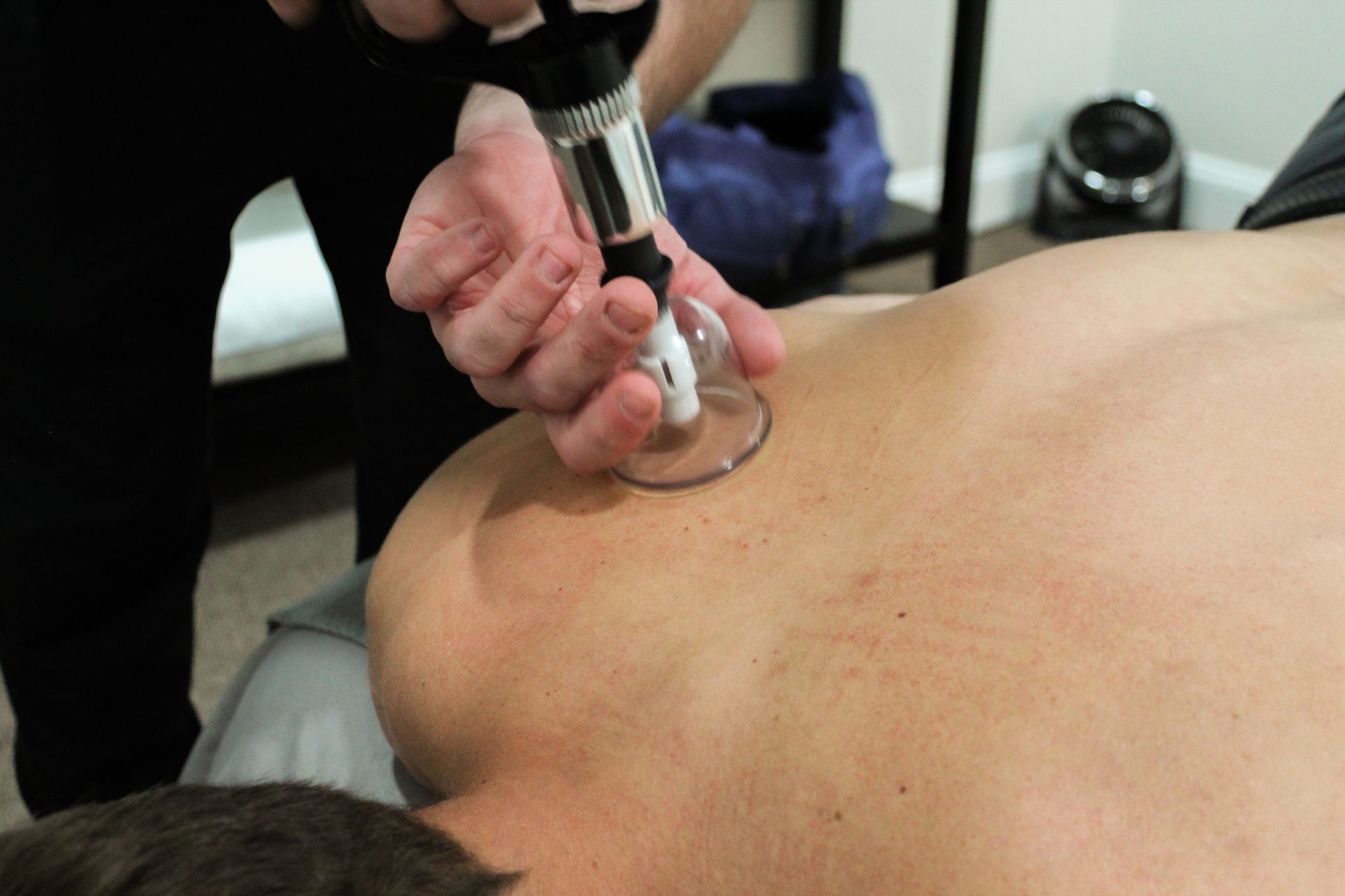 A man with cupping therapy on his back, standing by a chalkboard with game scores.