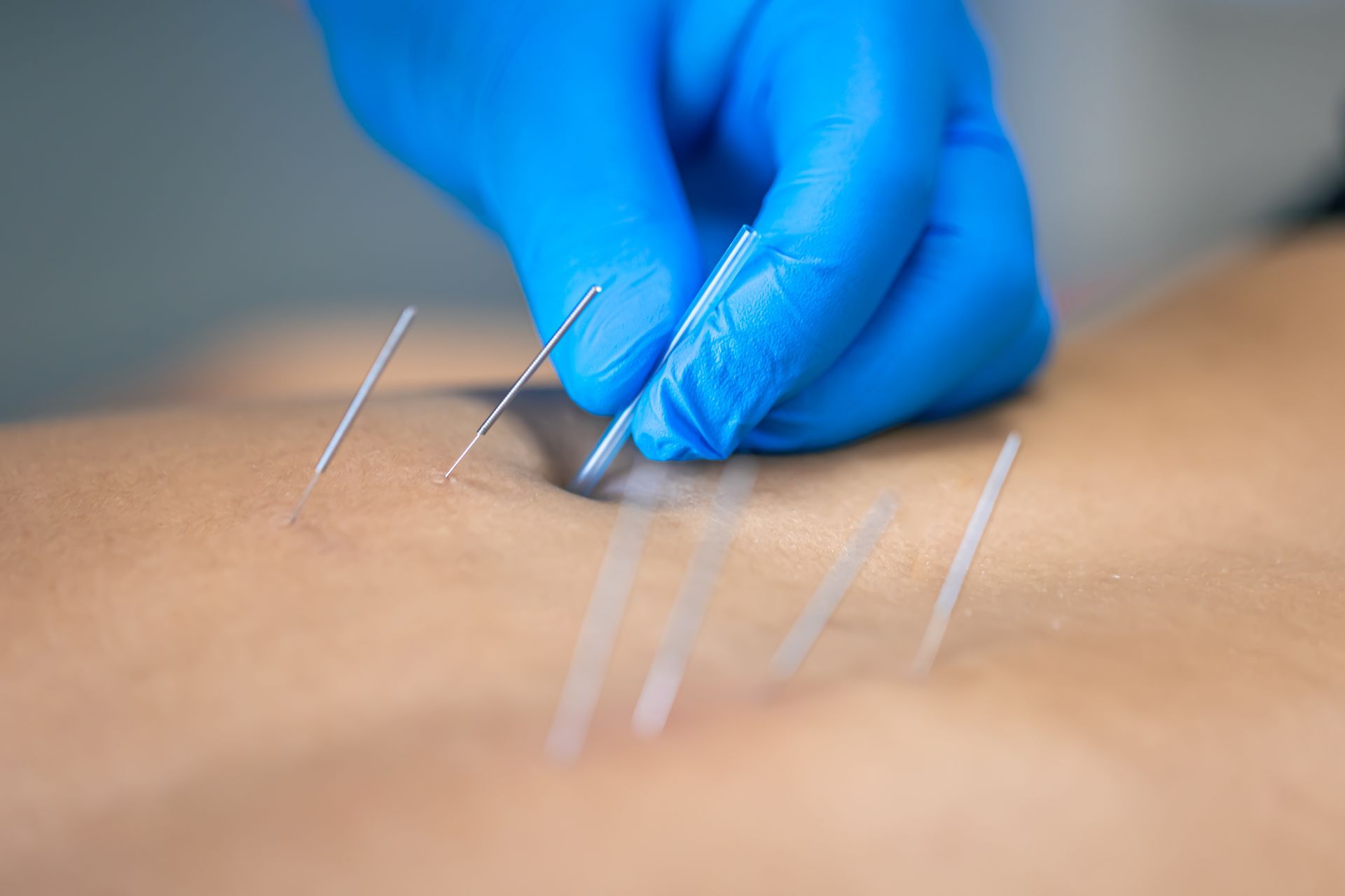 Blue-gloved hand doing dry needling into a person's back.