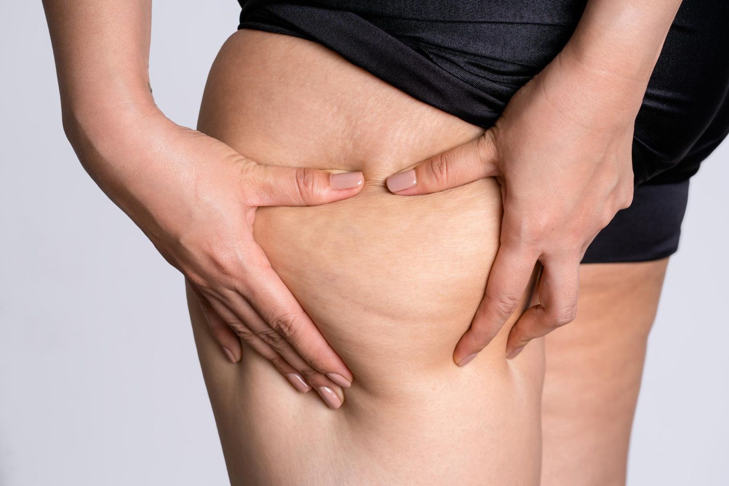 Hands pinching thigh skin, showing cellulite on a person’s leg