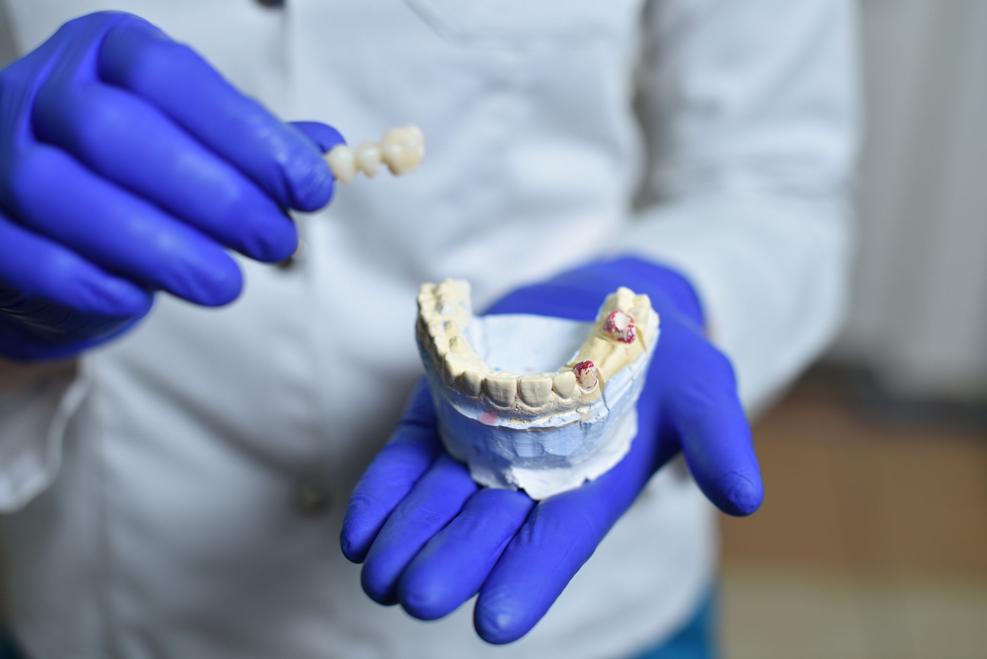 Un dentista con i guanti blu tiene in mano un ponte dentale e uno stampo dei denti.