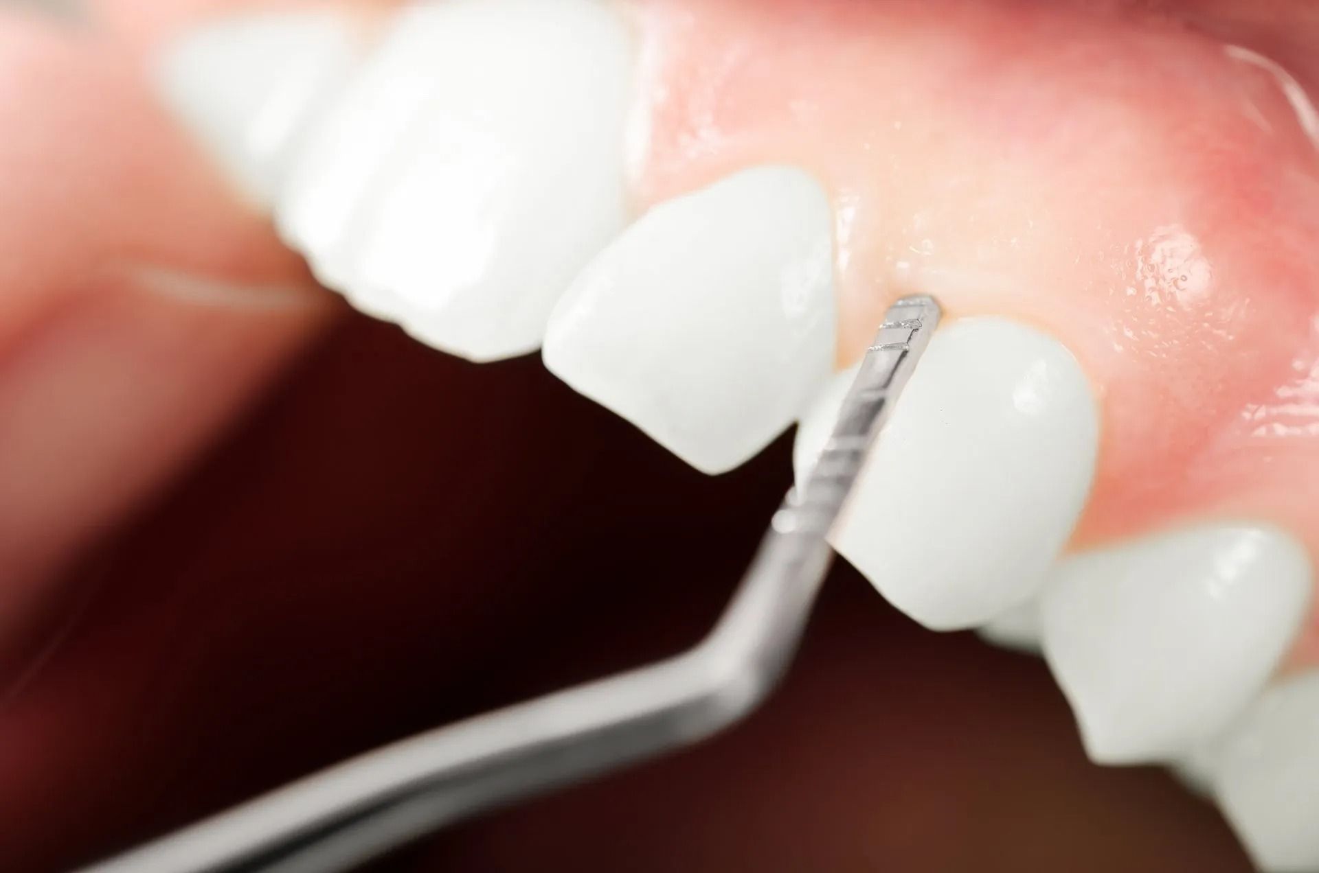 Igienista dentale che pulisce i denti con uno scaler.