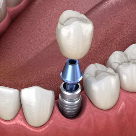 Dental Implants Alexandria VA