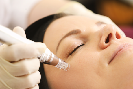 Microneedling