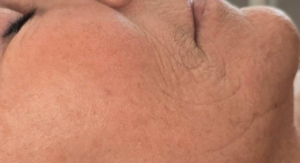 Vorher Seidenfadenlifting