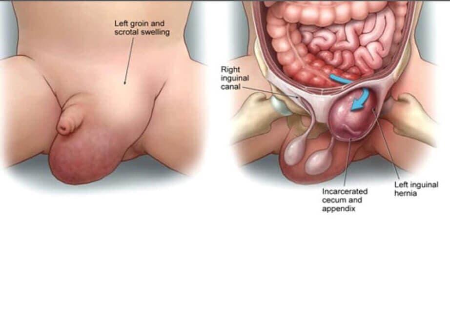 DR. PEDRO AGUIRRE RAMÍREZ - Hernia inguinal