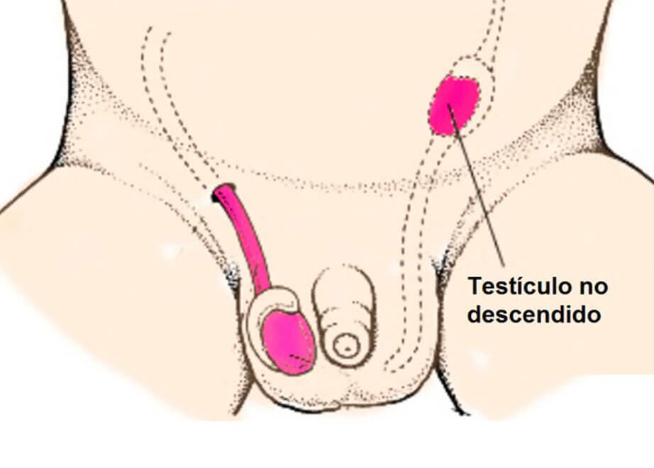 DR. PEDRO AGUIRRE RAMÍREZ - criptorquidia o testículo no descendido