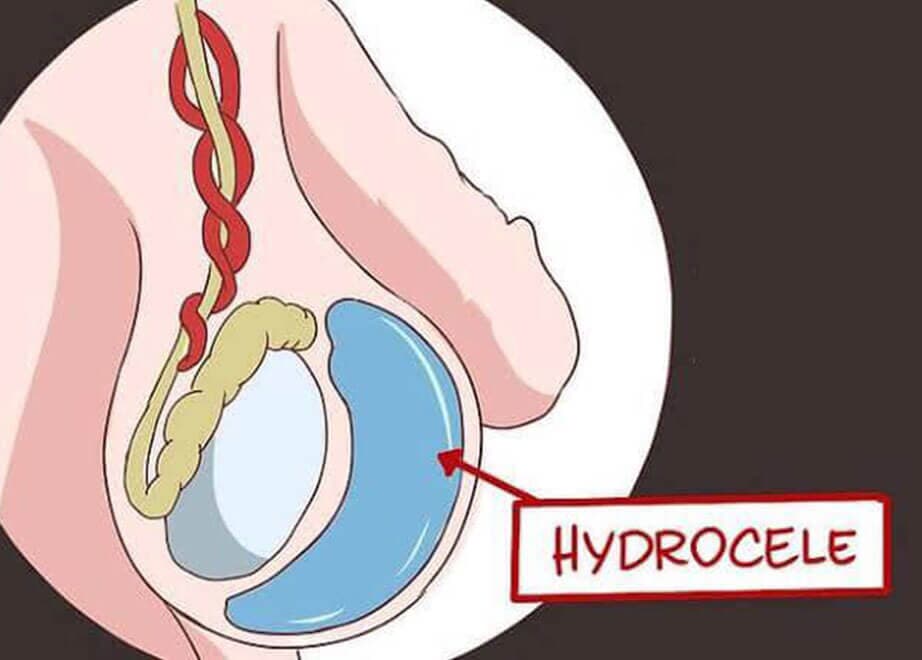 DR. PEDRO AGUIRRE RAMÍREZ - Hidrocele