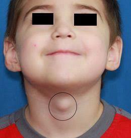 DR. PEDRO AGUIRRE RAMÍREZ - Quiste Tirogloso