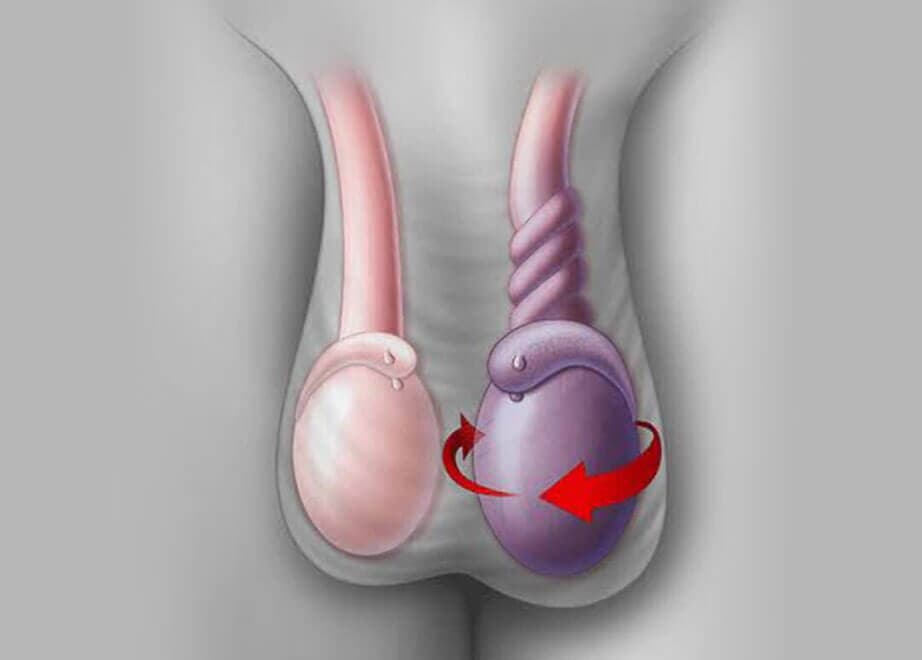 DR. PEDRO AGUIRRE RAMÍREZ - Torsión testicular