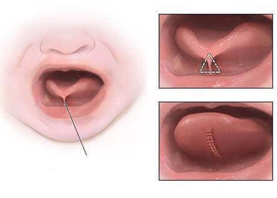 DR. PEDRO AGUIRRE RAMÍREZ - Frenillo lingual corto