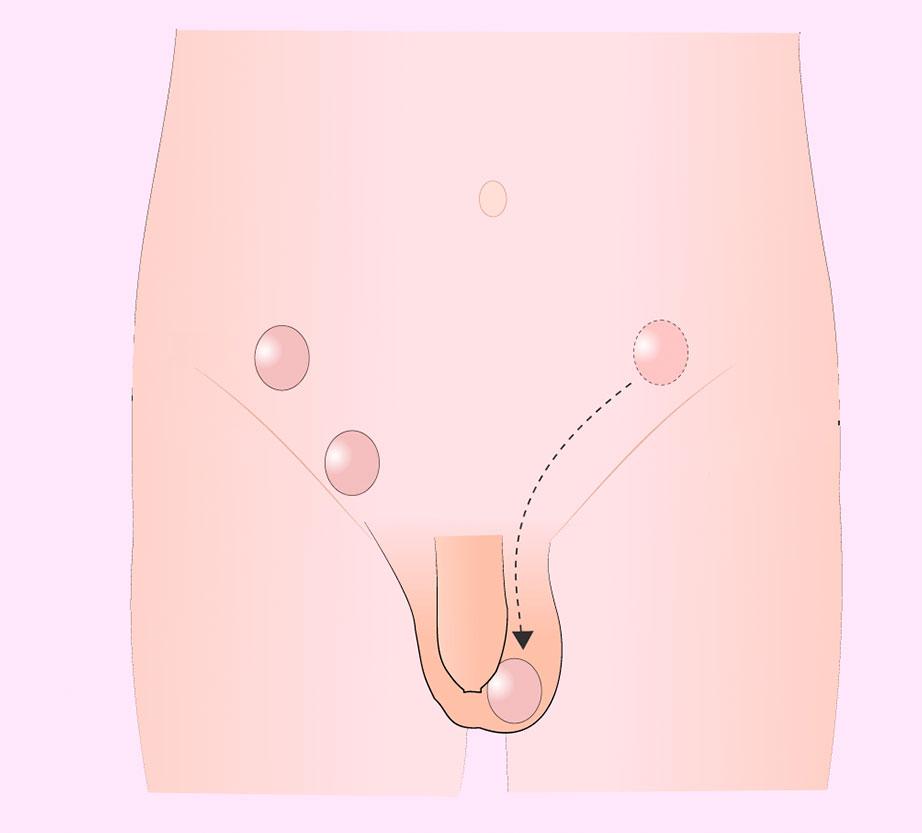 DR. PEDRO AGUIRRE RAMÍREZ - Testículo retráctil o en elevador 