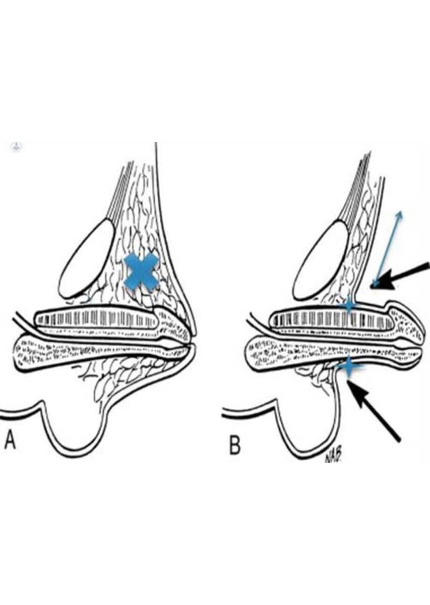DR. PEDRO AGUIRRE RAMÍREZ - Pene poco evidente u oculto