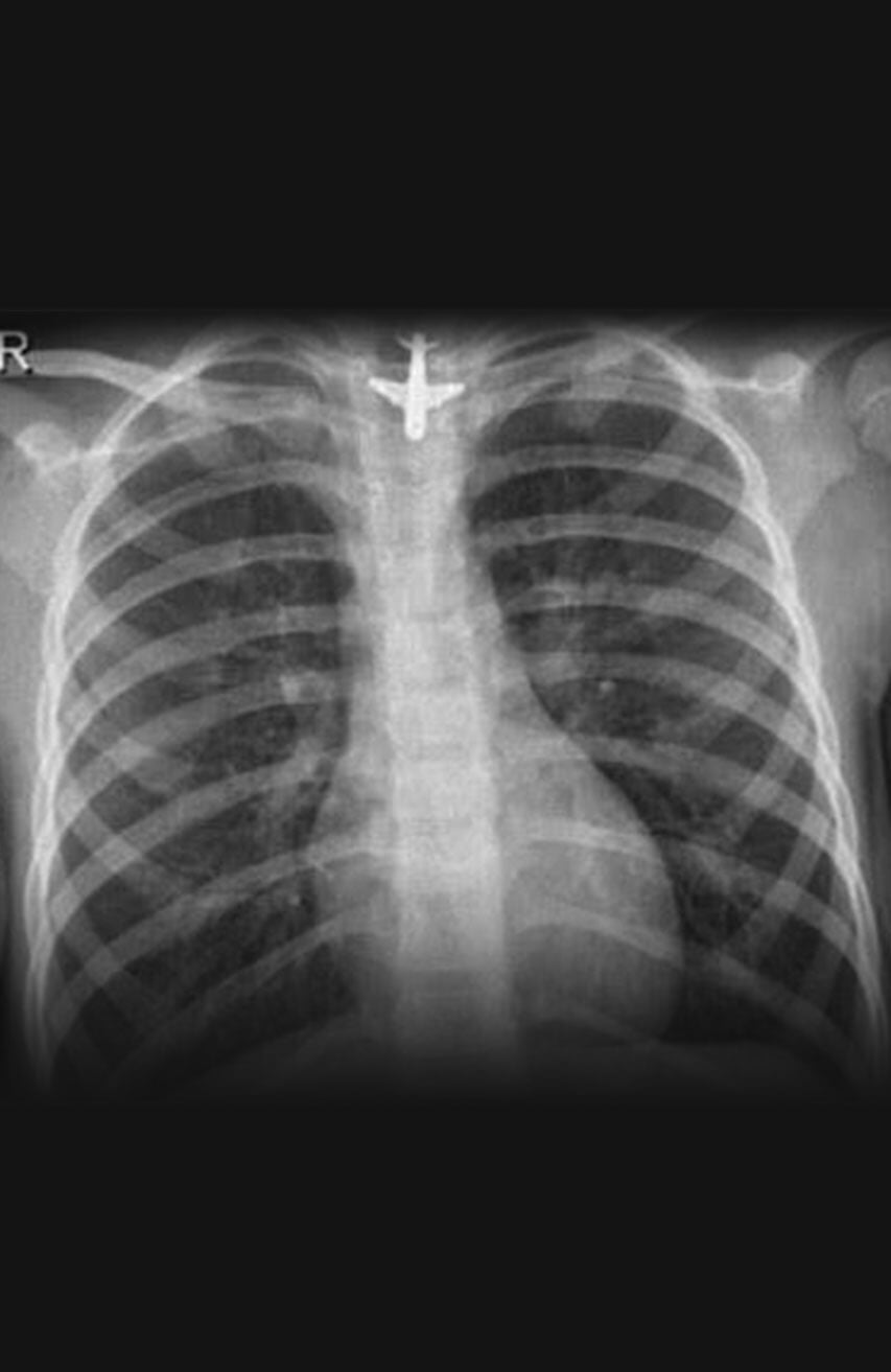 DR. PEDRO AGUIRRE RAMÍREZ - Ingesta de cuerpos extraños