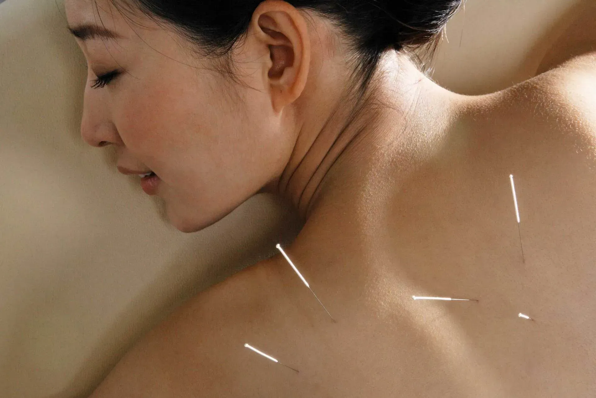 Woman receiving acupuncture treatment on her back with needles inserted. She's lying face down, relaxed, with a soft, neutral background.