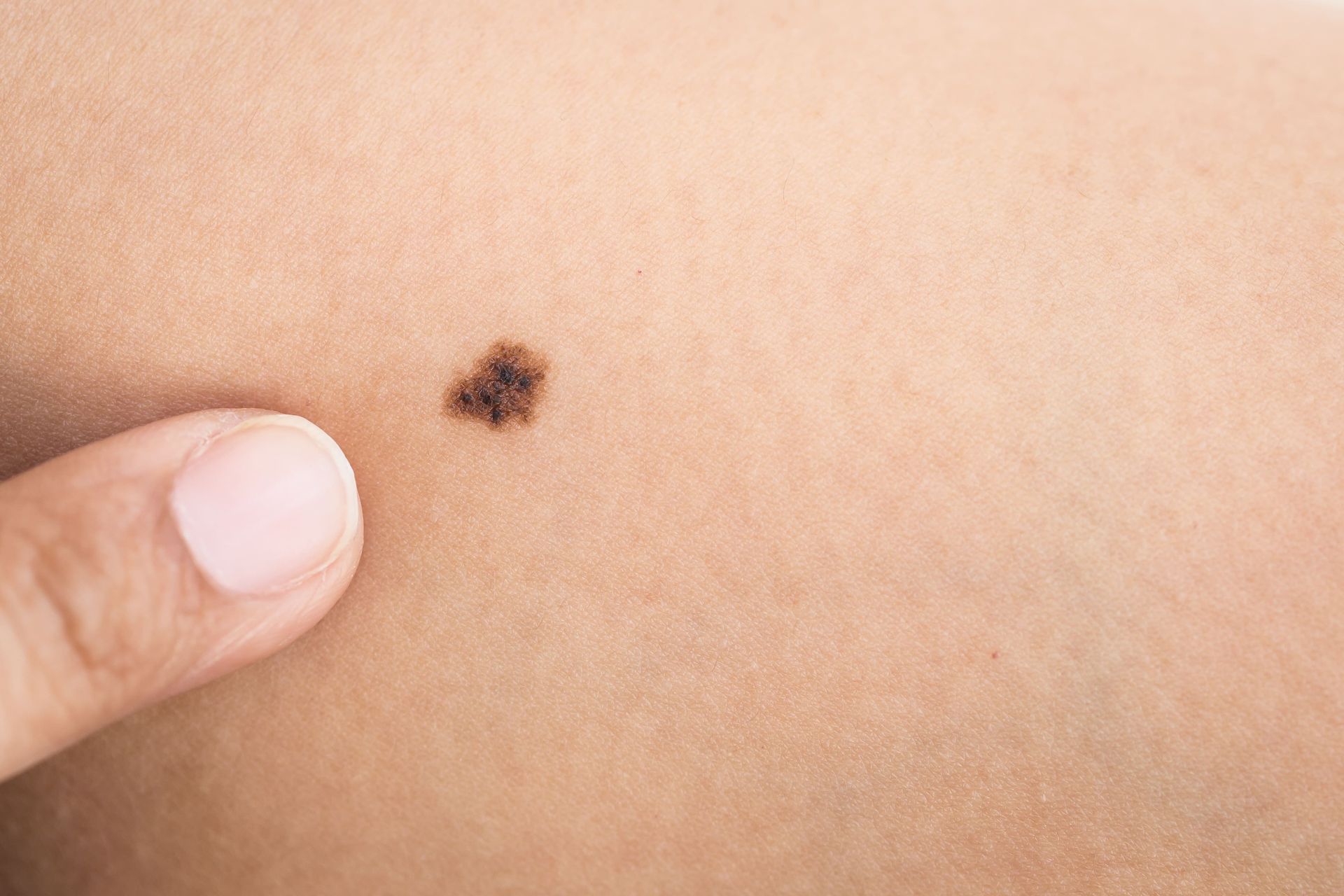 melanoma estágio 1