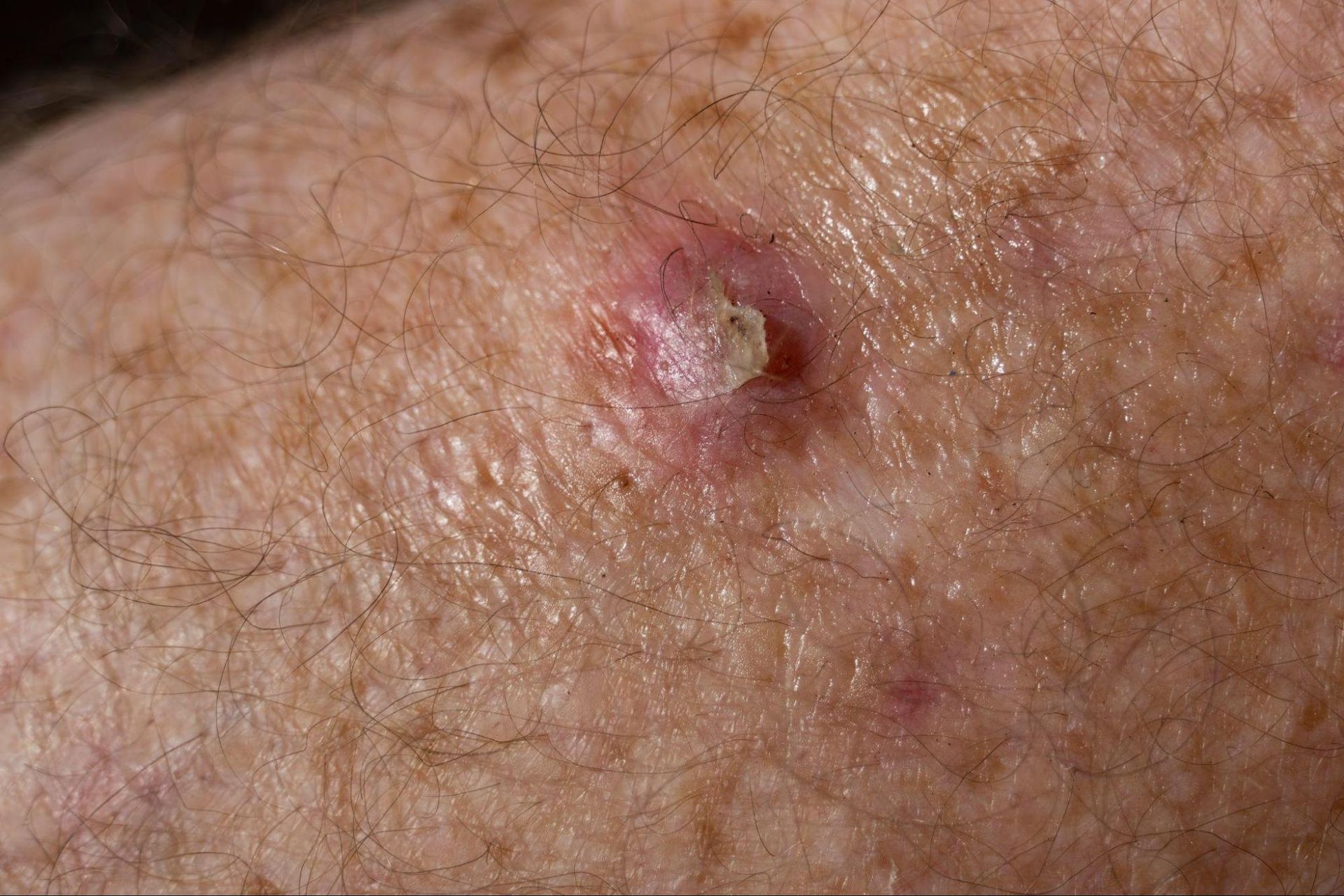 carcinoma espinocelular é grave
