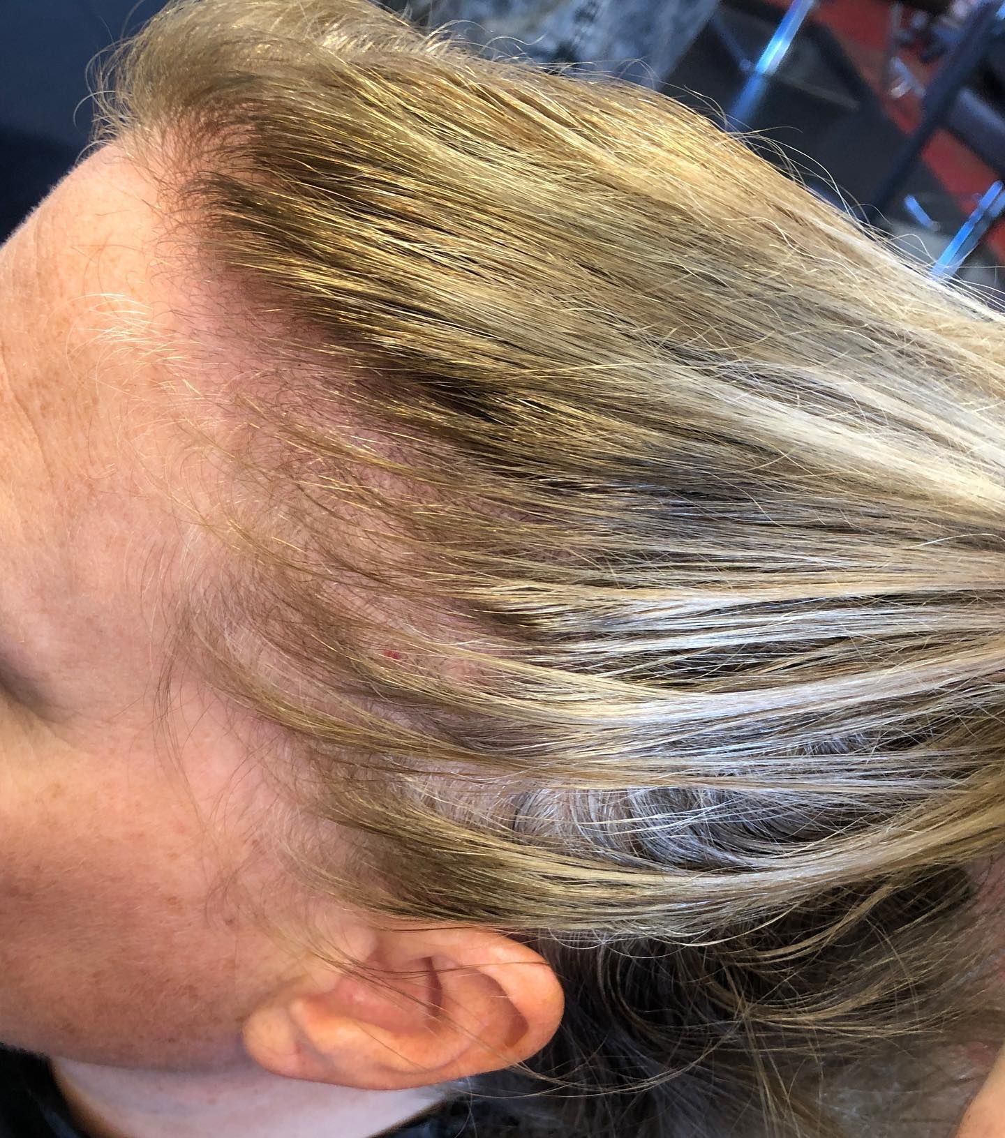 Close-up of hair, blond highlights, showing thinning at the hairline and scalp.