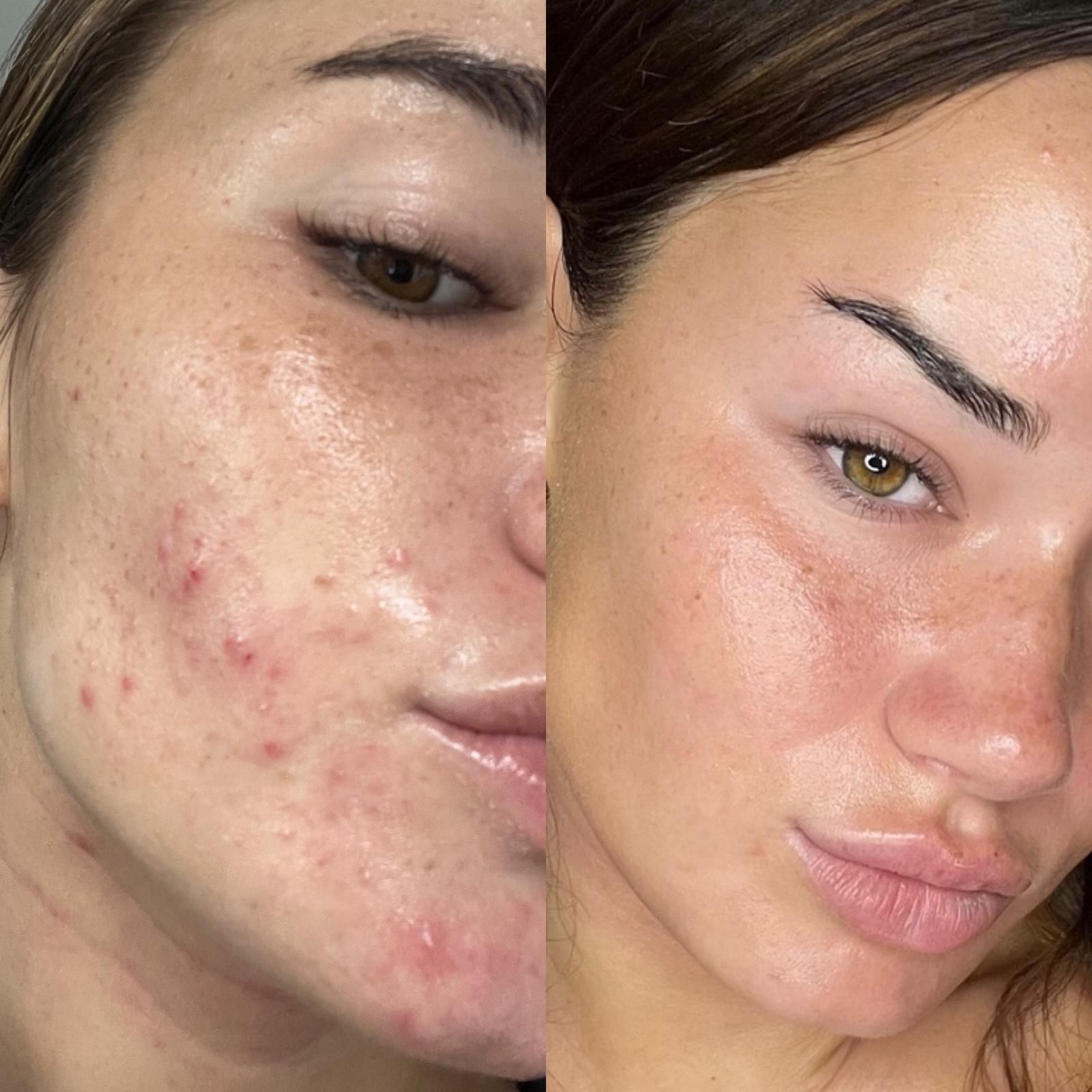 Woman Receiving a Facial Treatment With a Handheld Device — Eternal Radiance in Strathmore, VIC