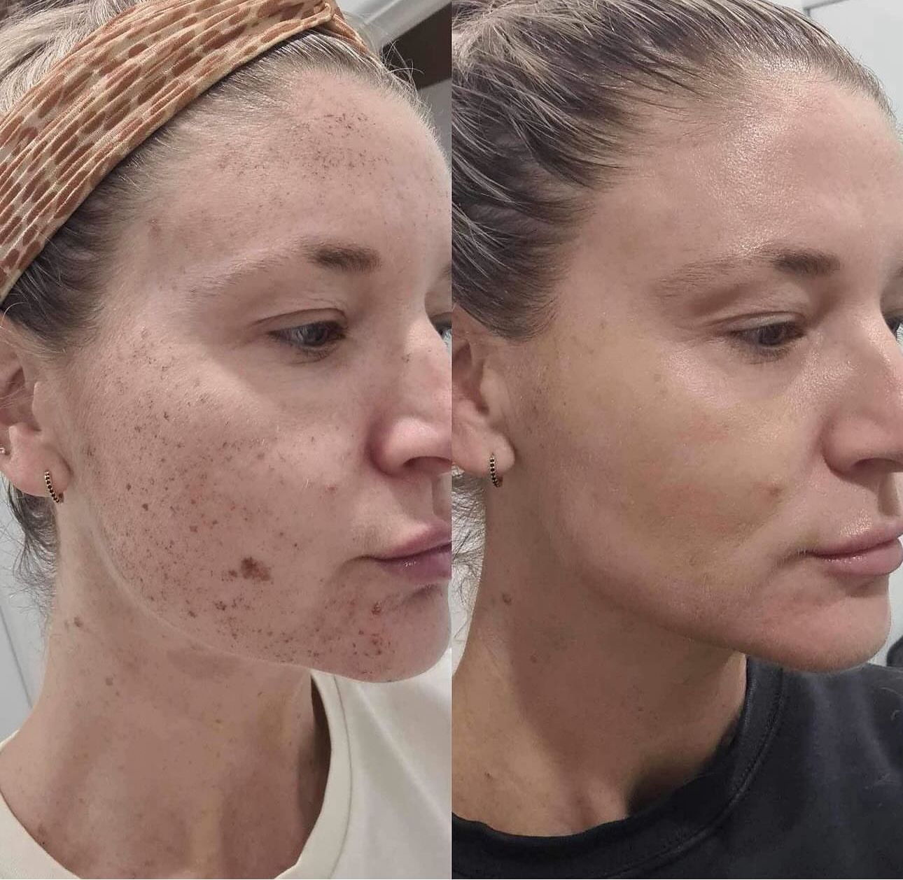 Before and After Comparison of Facial Skin With and Without Dark Spots — Eternal Radiance in Strathmore, VIC