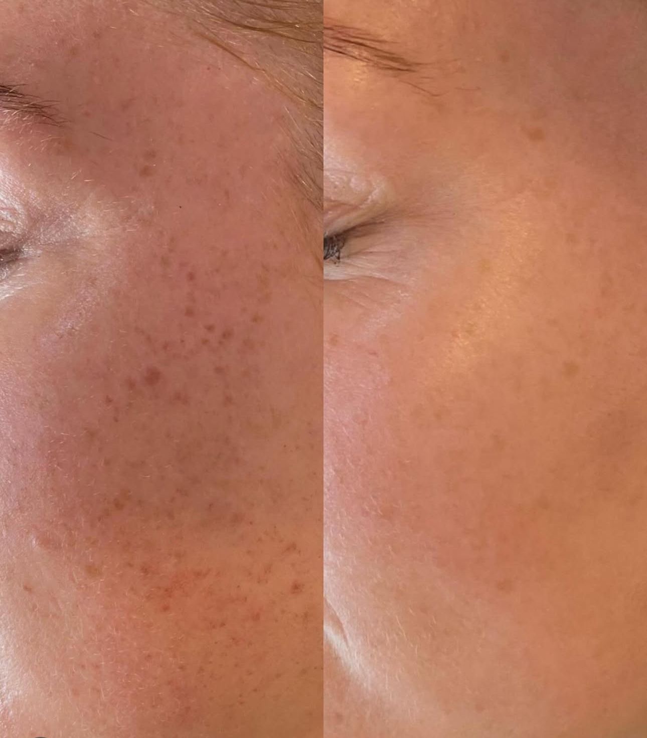 Woman Receiving Facial Treatment at a Spa, Esthetician Holding Device to Skin — Eternal Radiance in Strathmore, VIC