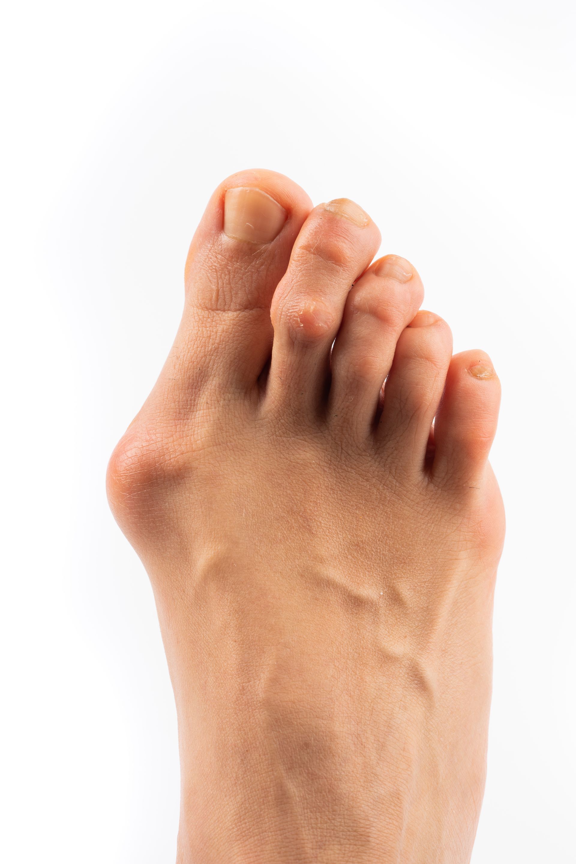Foot with a bunion on the big toe, viewed from above, on a white background.
