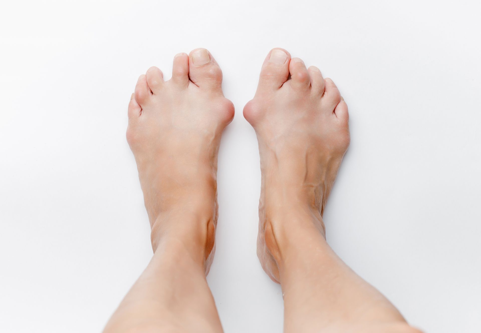 Bare feet with prominent bunions on a white background.