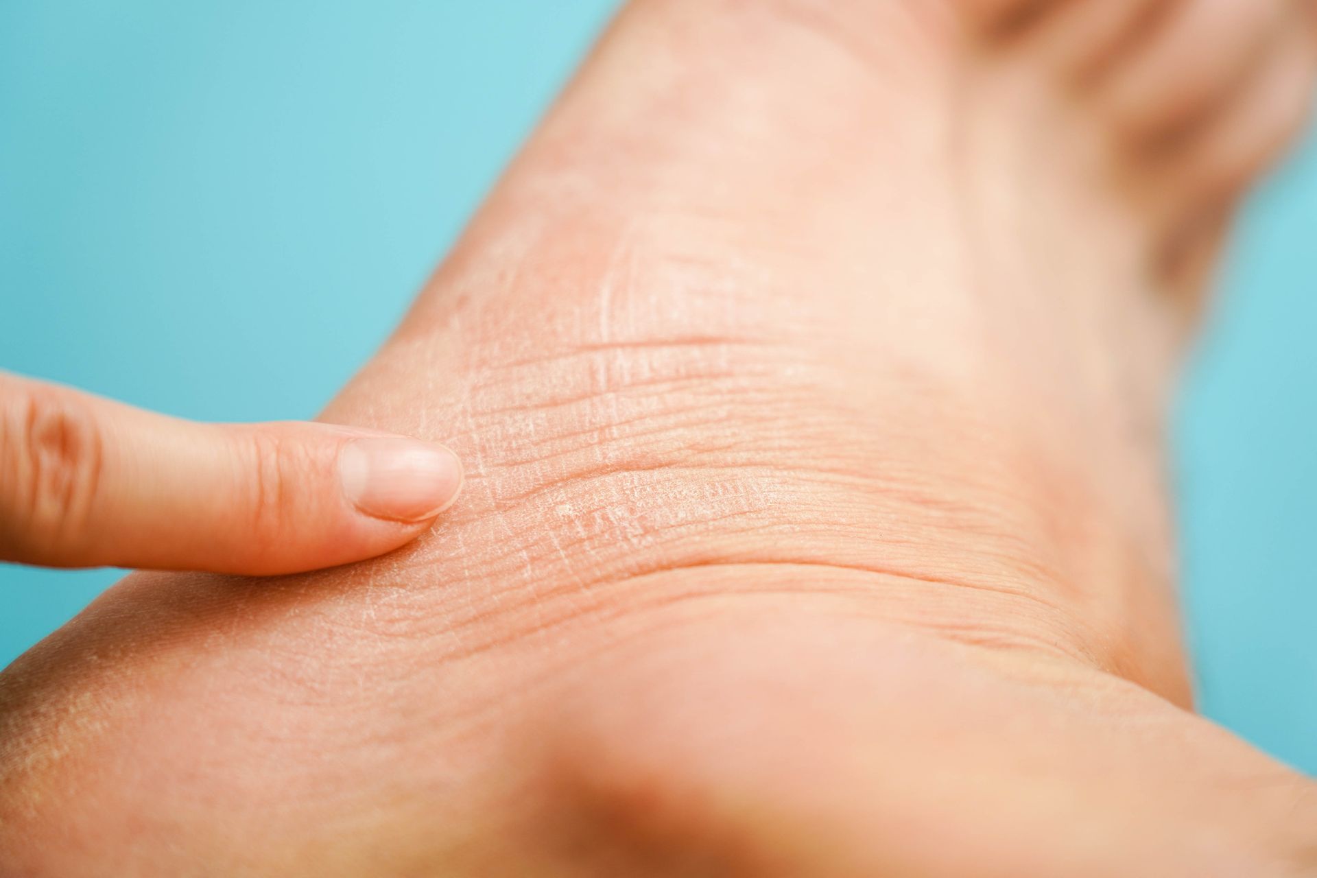 Finger pointing at dry, cracked skin on a foot, against a blue background.