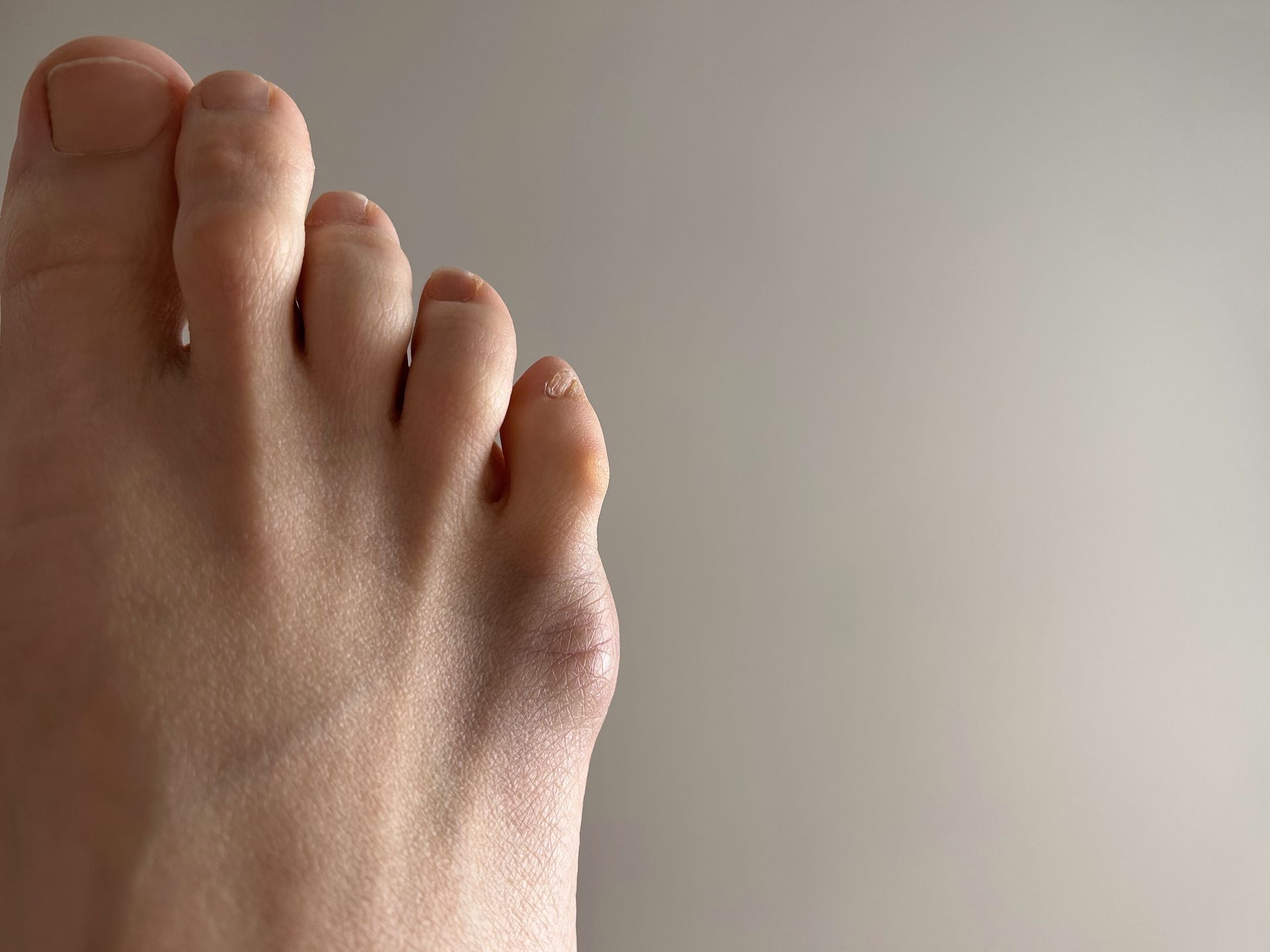 Foot with a prominent bunion on the outer side of the big toe, against a neutral background.