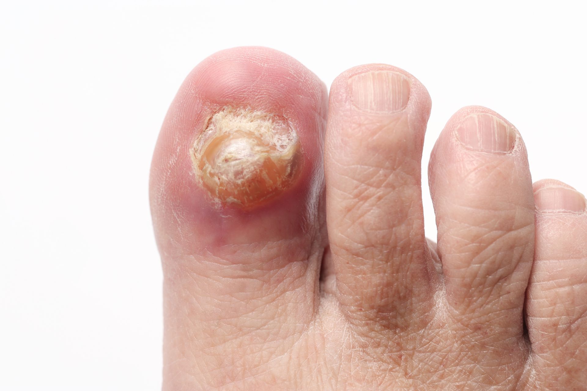 Foot with an infected, ulcerated toe, surrounded by red inflammation.