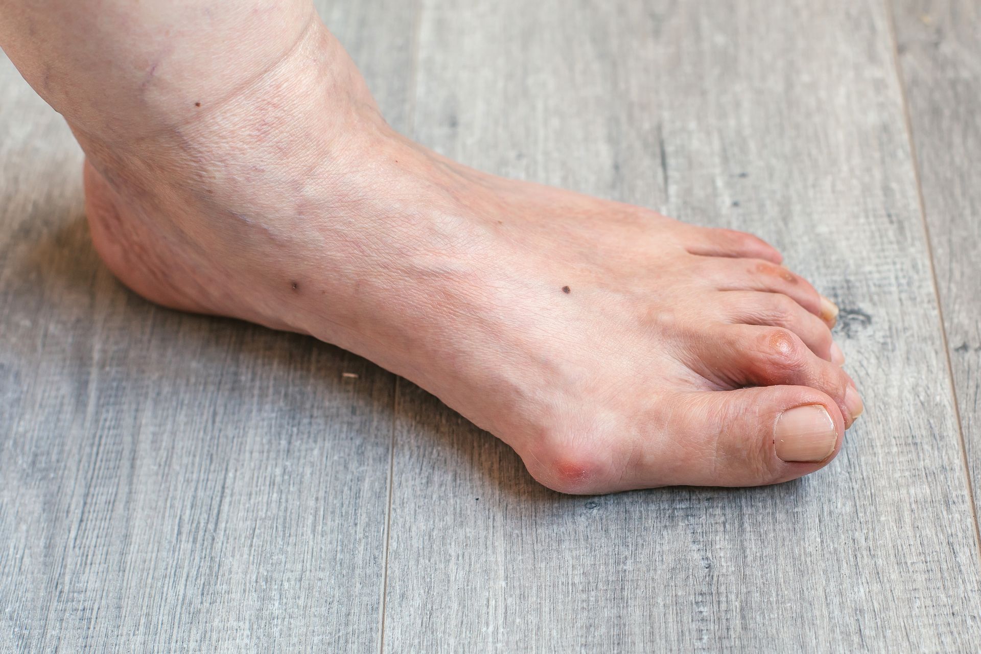 Foot with bunion, showing a bony bump at the base of the big toe.