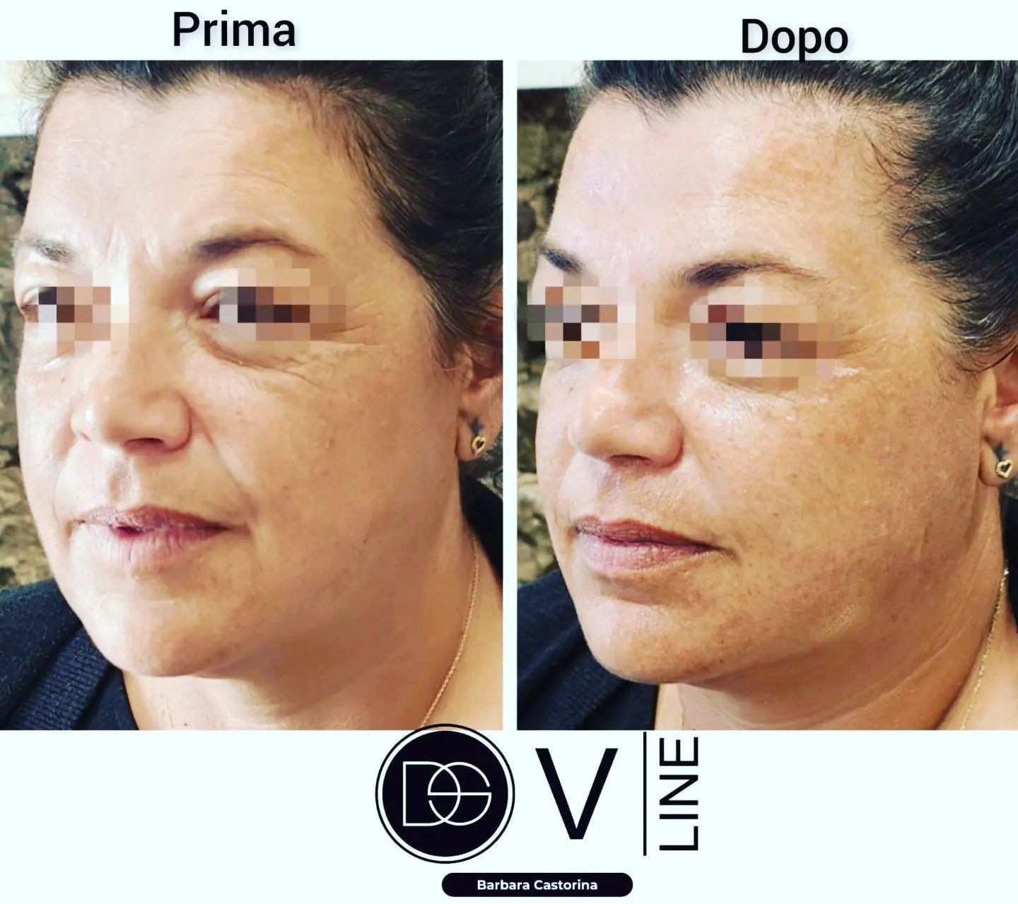 prima e dopo viso di una signora