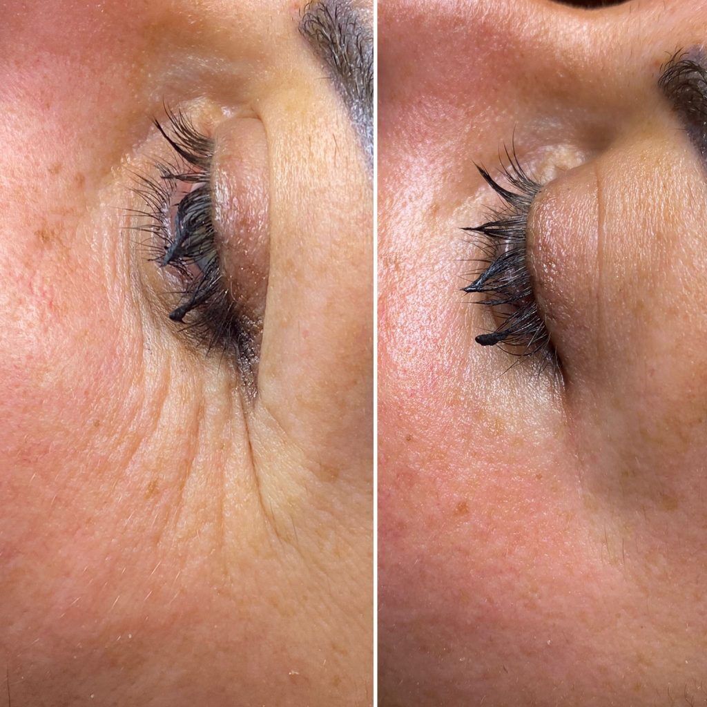 prima e dopo occhi