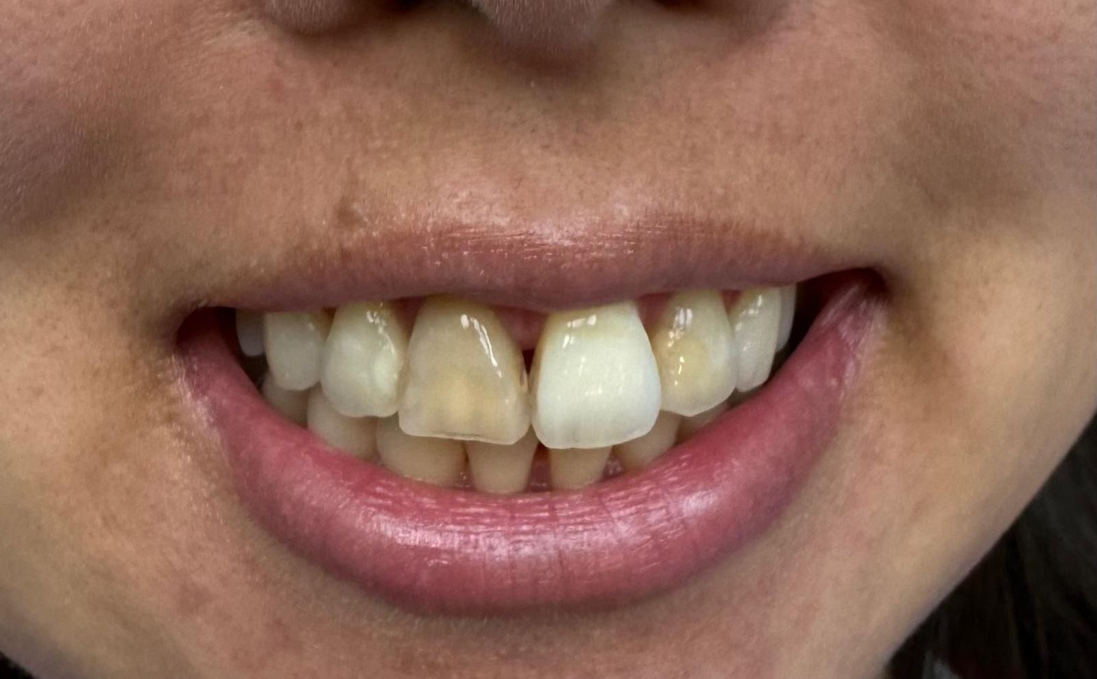 Resin veneers BEFORE & AFTER