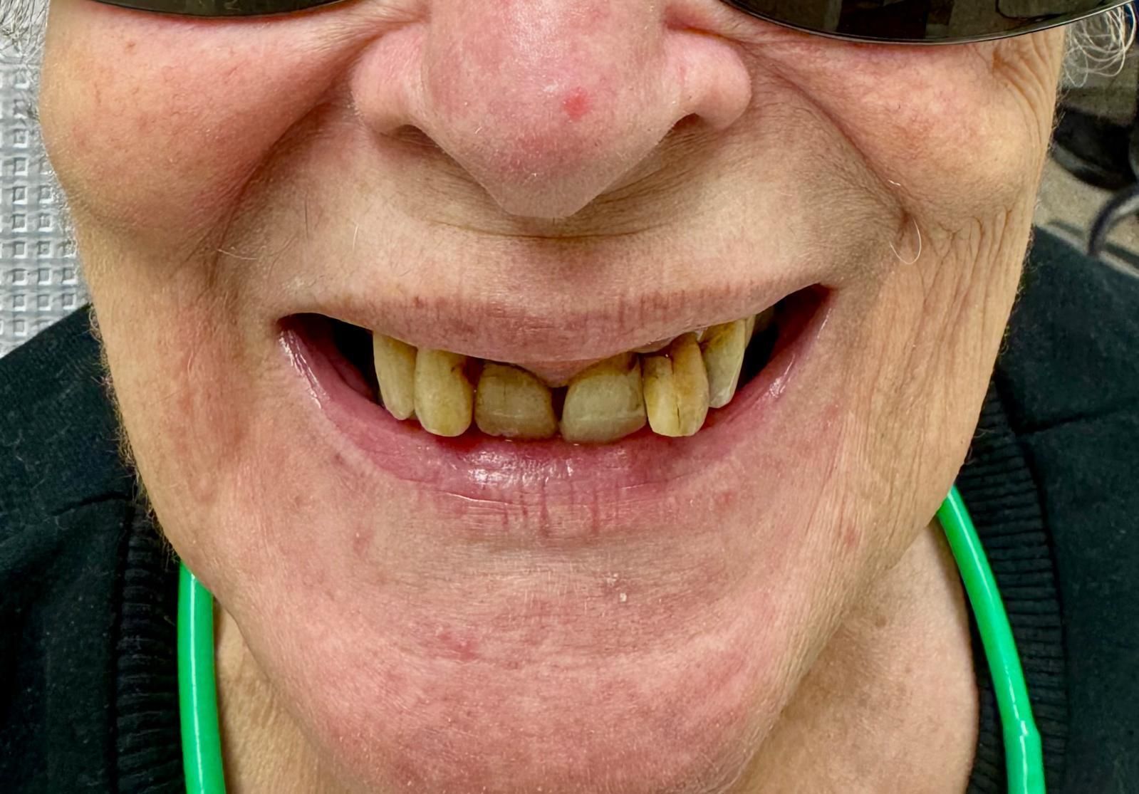 Resin veneers BEFORE & AFTER