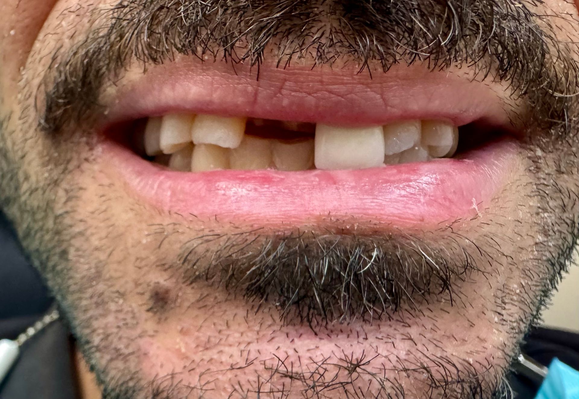 Broken tooth extraction BEFORE & ATFER