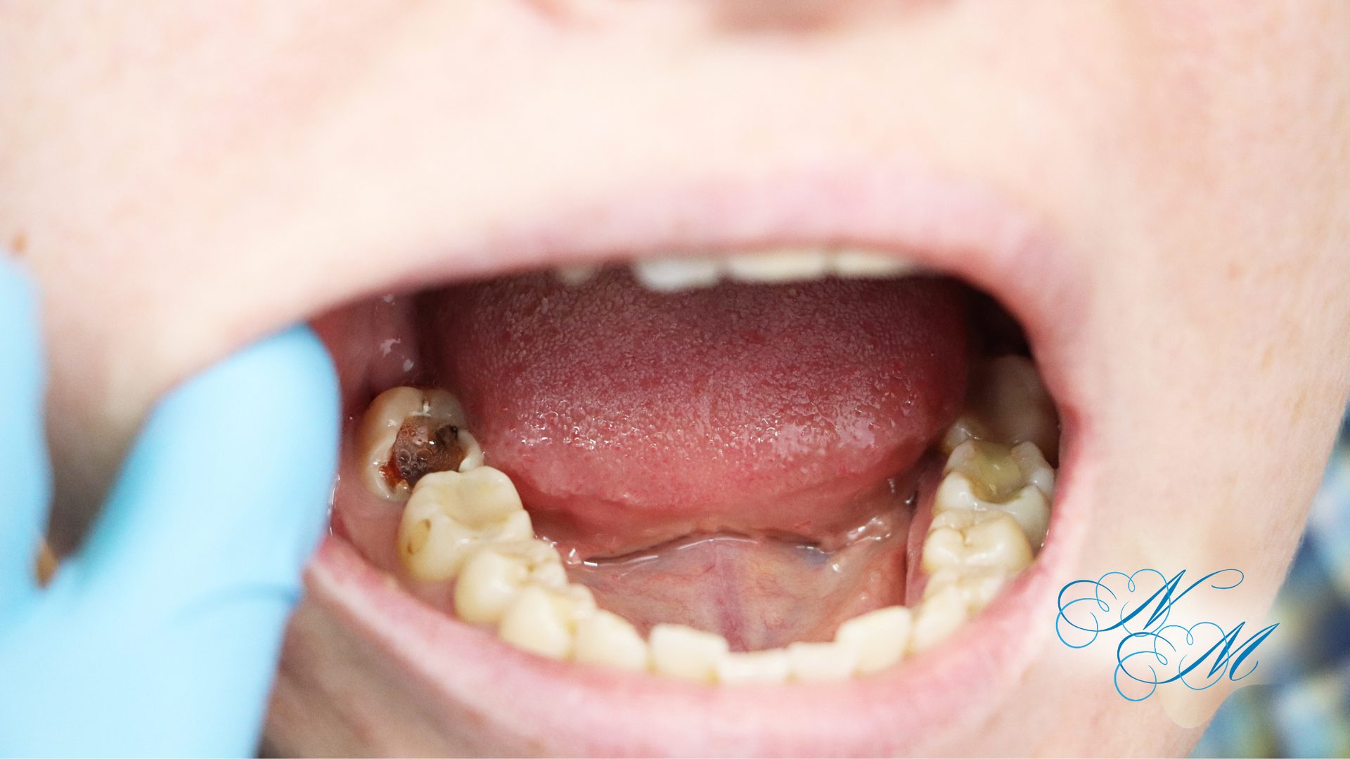 Mouth with decayed teeth; a gloved hand pulls the cheek back.